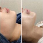 ビフォーアフター３（フェイスライン）