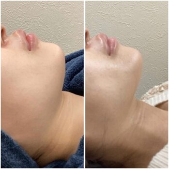 ビフォーアフター３（フェイスライン）