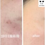ビフォーアフター（美肌コース）