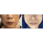 ビフォーアフター６（フェイスライン）