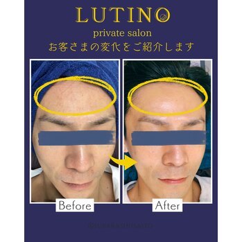 ビフォーアフター（男性の肌質改善もお任せください♪）