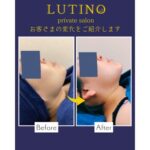 ビフォーアフター(脂肪溶解小顔コース)