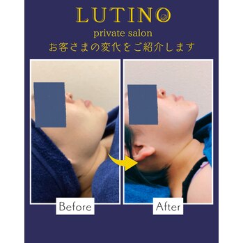 ビフォーアフター（脂肪溶解小顔コース）