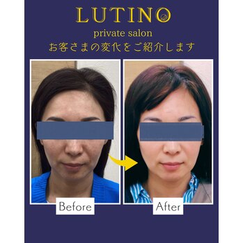 ビフォーアフター（リムーブ美容液導入コース）