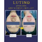 ビフォーアフター(ララピール)