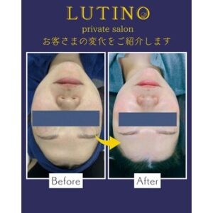 ビフォーアフター（ララピール）