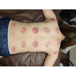 カッピング(吸い玉)は何に良いのか？