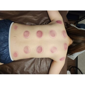 カッピング(吸い玉)は何に良いのか？