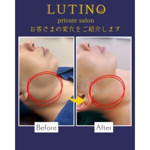 ビフォーアフター（グロッティ・脂肪溶解）