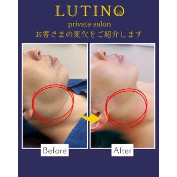 ビフォーアフター（グロッティ・脂肪溶解）