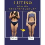 ビフォーアフター（セルライトケア）