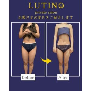 ビフォーアフター（セルライトケア）