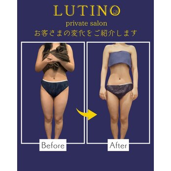 ビフォーアフター（セルライトケア）