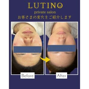 札幌のルチノでビフォーアフター（フェイシャル）