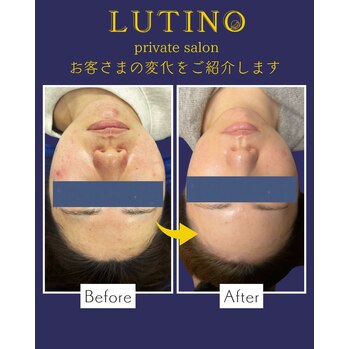 札幌のルチノでビフォーアフター（フェイシャル）