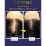 札幌のルチノでビフォーアフター（グロッティスカルプ）育毛・発毛！
