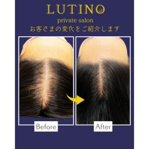 札幌のルチノでビフォーアフター（グロッティスカルプ）育毛・発毛！