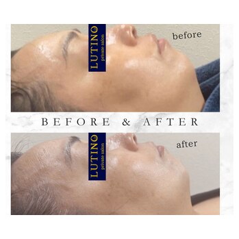 ビフォーアフター【究極の小顔】脂肪分解×ハイパーナイフ×グロッティ